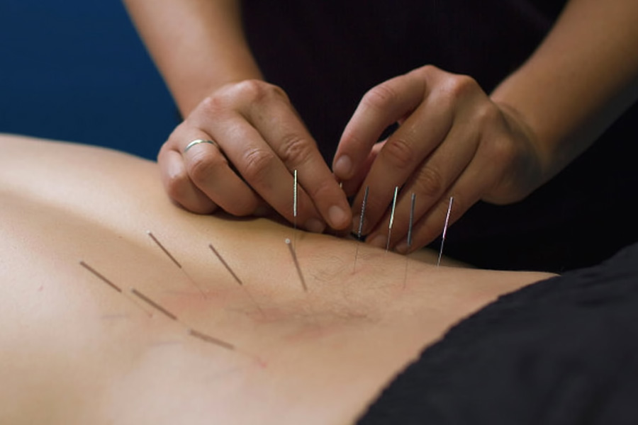 Dry Needling Therapy